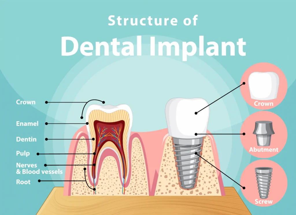 dental-implant-structure