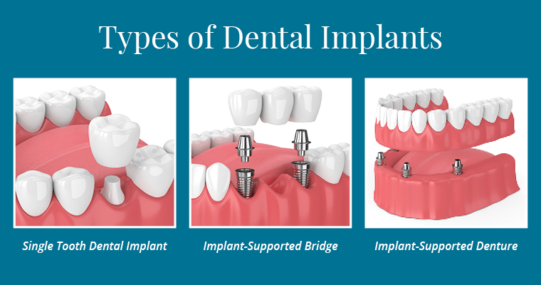 types-of-dental-implants
