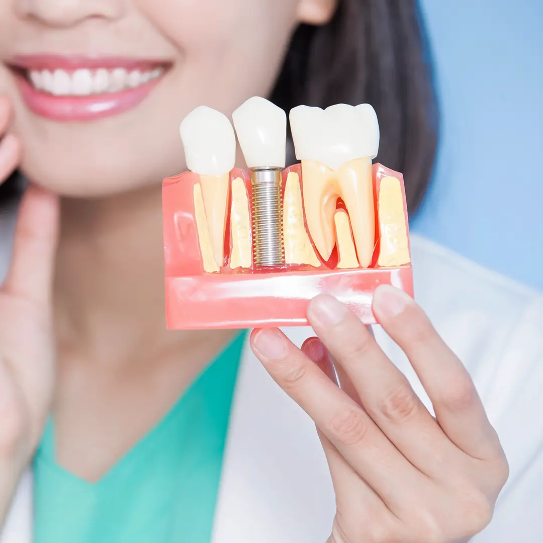 dental-implant-img1 Dental Implant Image
