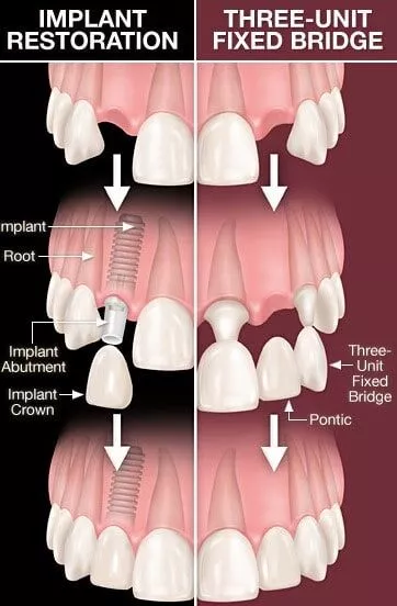 dental-implant-vs-dental-bridge