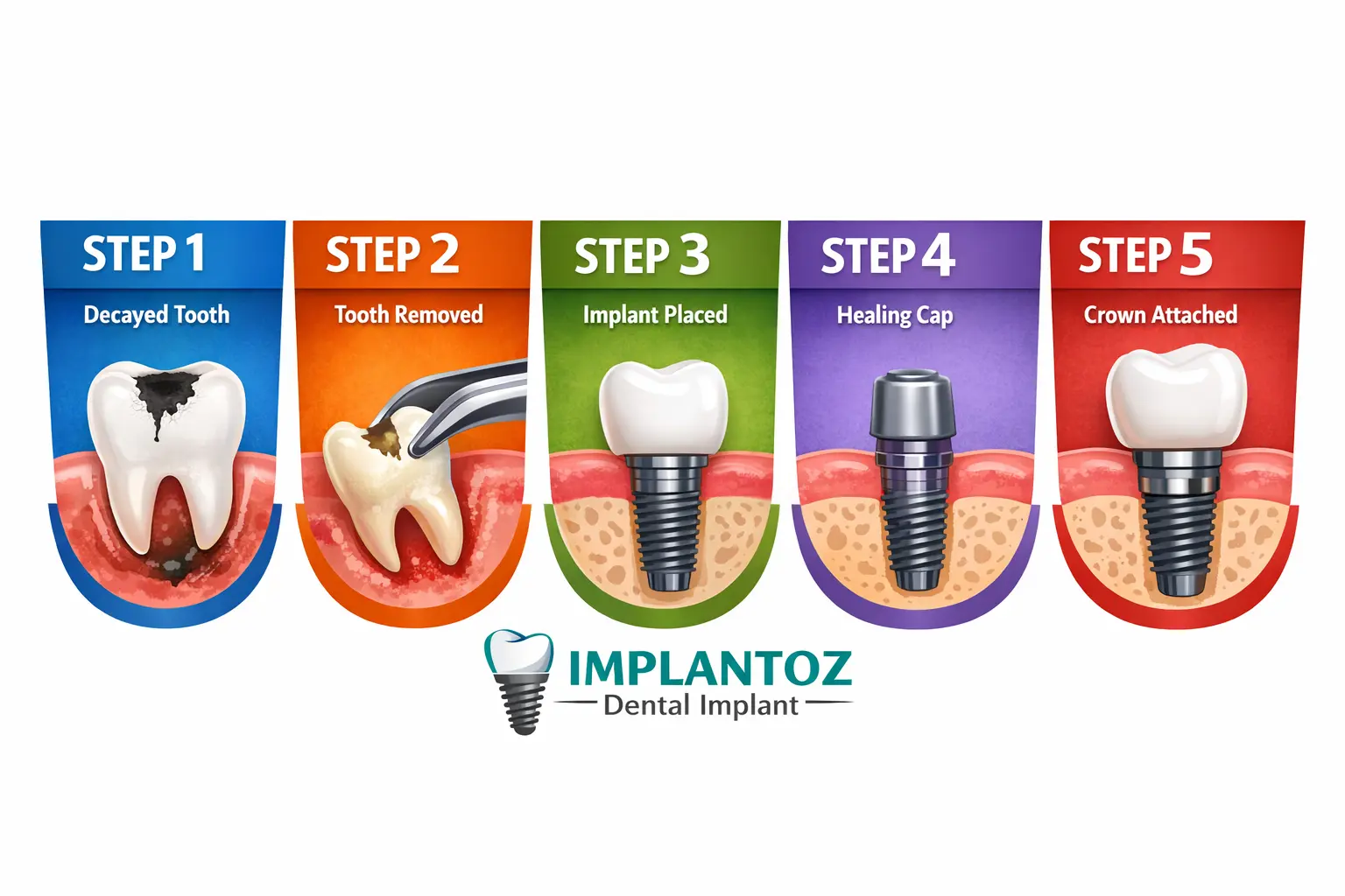 dental-implant-procedure Dental implant procedure at dental implant clinic in Gurgaon